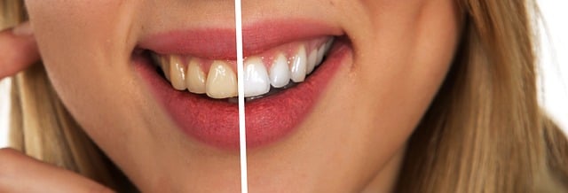 rozdíl v barvě zubů